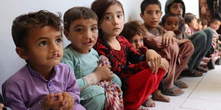 هلمند کې د پرې شونډو ۶۷ ماشومانو درملنه شوې