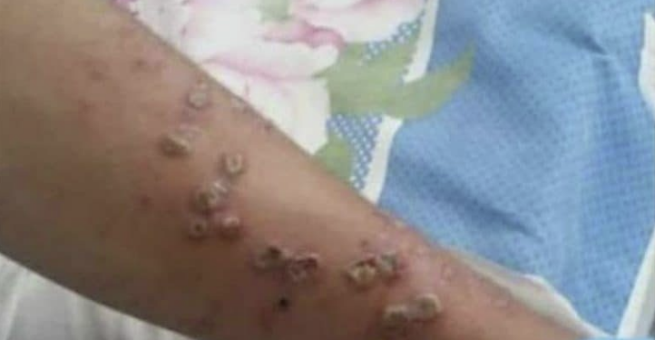 روغتیا وزارت: د بيزو چيچک د مخنیوي لپاره مو لازم تدابیر نیولي