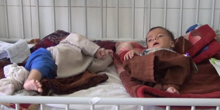 یونیسف: تېر کال مو پر خوارځواکۍ د اخته ۶۱۰ زره افغان ماشومانو درملنه کړې